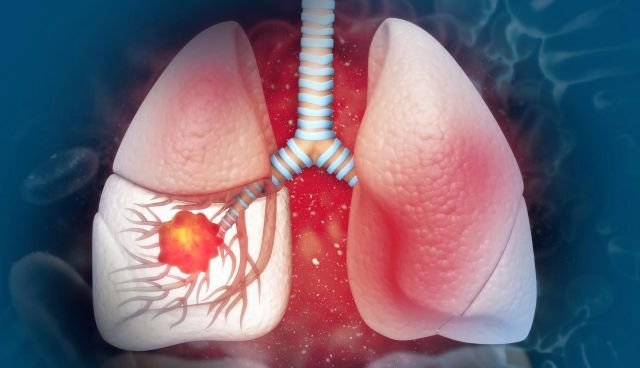 Sociedad Oncología dice 80% cáncer pulmón se asocia tabaco imagen